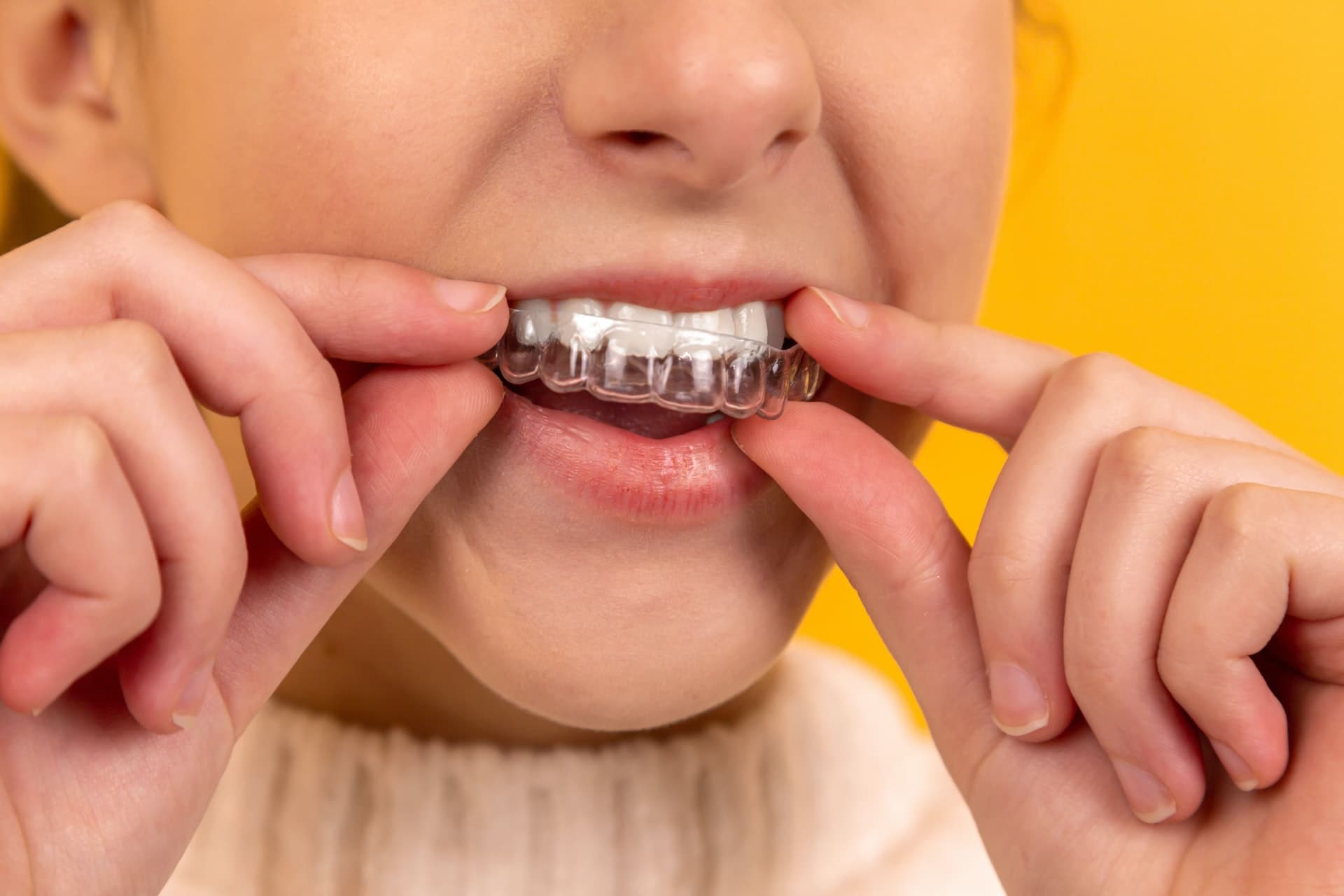 Wybielanie nakładkowe zębów – przebieg, czas trwania, efekty